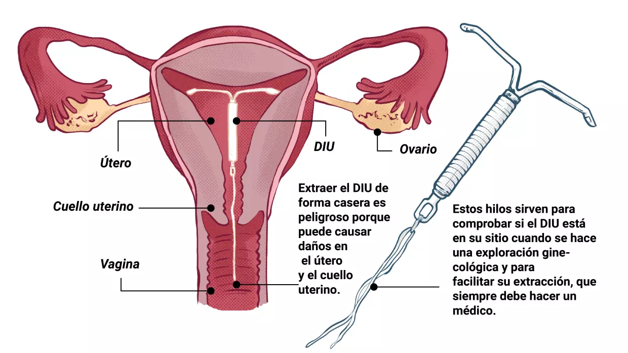 O melhor m\u00e9todo contraceptivo \u00e9 o Diu?s - Dra Greice Chetta