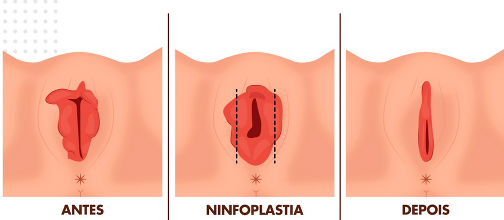 Ilustração que mostra a estética da vulva feminina antes, durante e após o procedimento da nilfoplastia, a cirurgia íntima da mulher